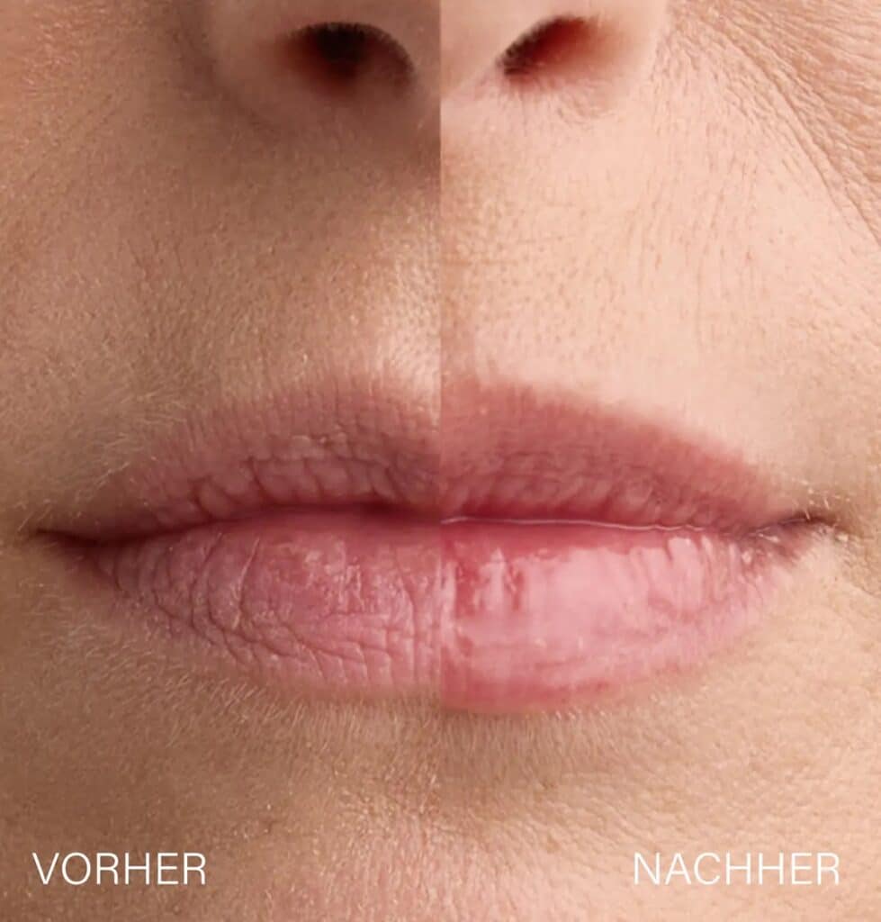 Direkter Vorher-Nachher-Vergleich der Lippen nach Anwendung des Rosental Lip Plumpers.