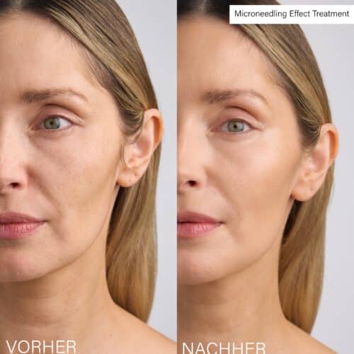 Vorher Nachher Microneedling Effect Treatment Rosental Organics Erfahrungen 2026 Hautbild glatter und strahlender