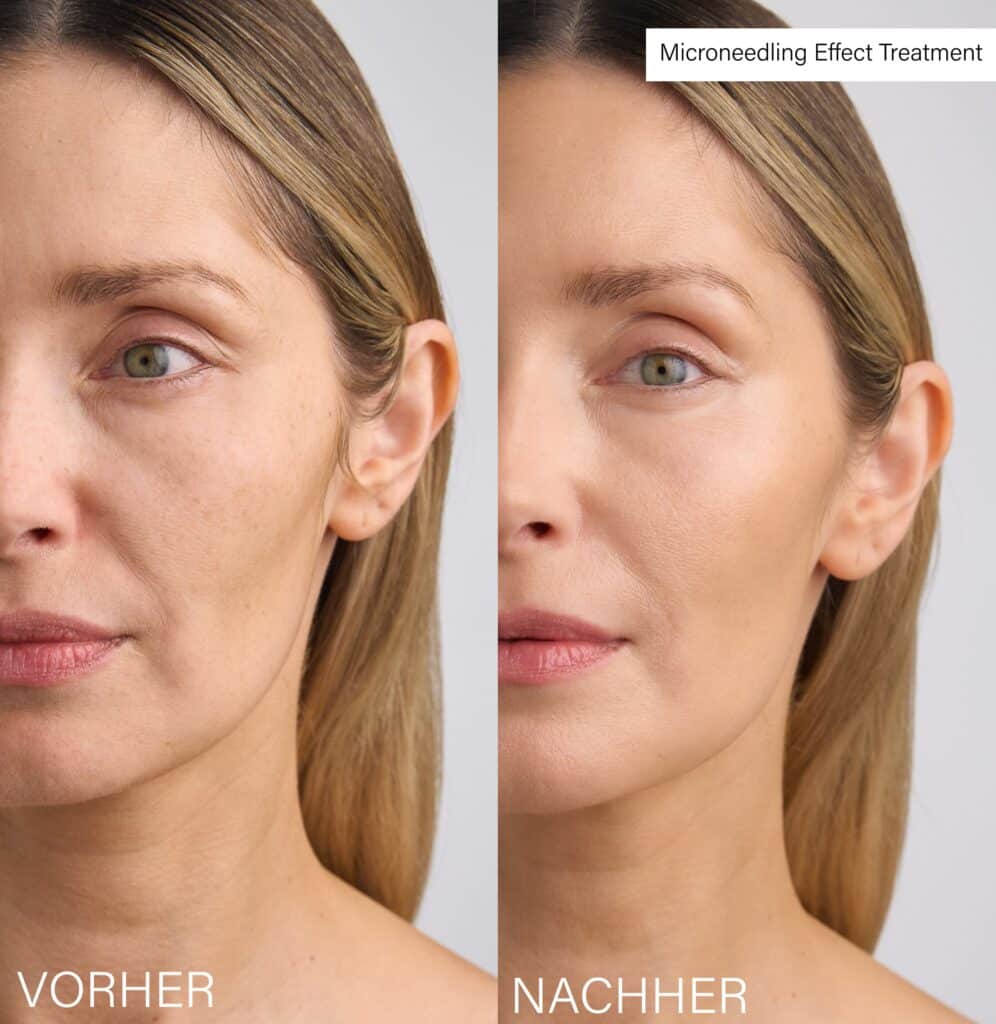 Vorher Nachher Microneedling Effect Treatment Rosental Organics Erfahrungen 2026 Hautbild glatter und strahlender